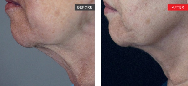 Fotona 4D results