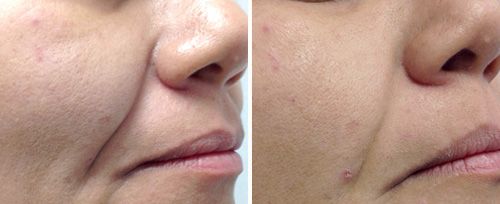 Full face rejuvenation results